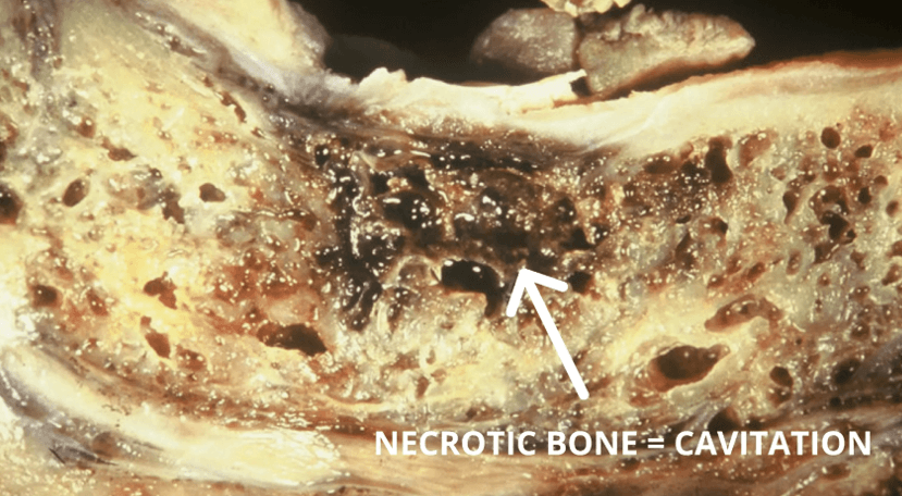 What Are Jawbone Cavitations?